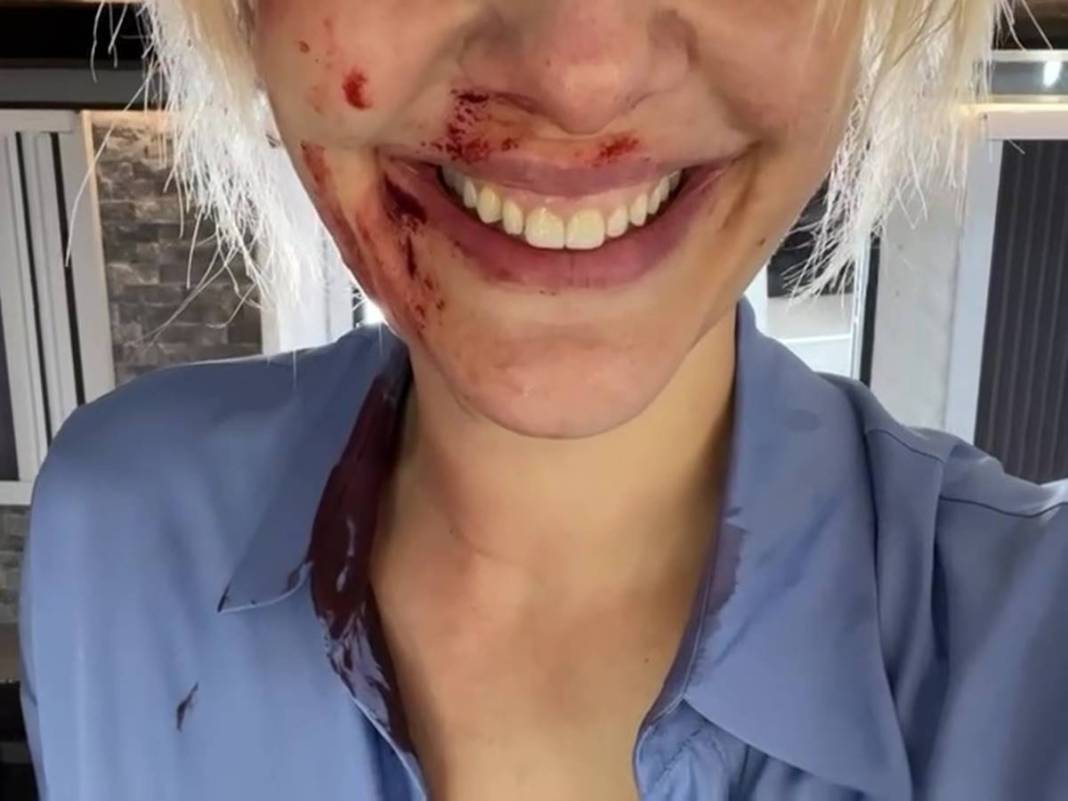 Bergüzar Korel'in kanlı paylaşımı takipçilerini korkuttu! Neden paylaştığı daha sonra ortaya çıktı 8